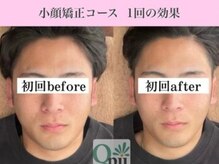 キュープ 下北沢店(Qpu)/ 小顔矯正コース1回の変化