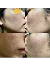 ブリーズ(Breeze)/ハーブピーリング