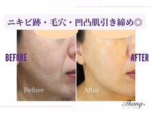 サンク(Thanq)/毛穴悩みも◎ふっくら滑らか肌に