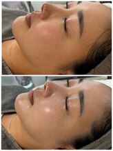 彌庵/次世代毛穴洗浄（全顔）　症例