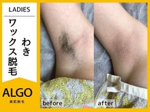 アルゴ 敦賀店(ALGO)/10代女性３回目　WAX+光脱毛