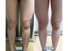 《夏目前人気No.1》足のムダ毛脱毛