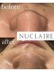 ここはなの写真/お顔の脱毛が気になる方へ♪【フェイシャル脱毛ワックス(90分）￥10,800→￥8,800】トーンアップ効果も◎