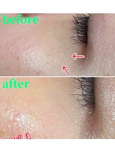 ナチュウル(Natulu)/WAXだと取れない目元の産毛