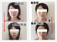 あかり整体の雰囲気（小顔矯正・3回目のビフォーアフター。不調に合わせた慎重な施術）