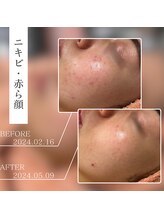 ベストベル(BestBelle)/ハーブピーリングでツヤ肌に！！