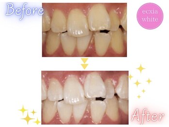 エクシアホワイトニング 天王寺店/ホワイトニングビフォーアフター