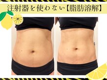 クリニカルエステ イーズ イオンモール筑紫野店の雰囲気（レモンボトルで　脂肪にアプローしてシェイプアップ）