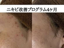 アエオボンヌール(A.E.O BONHEUR)/こめかみニキビ改善