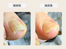 ルポ 伊勢/巻き爪ケア