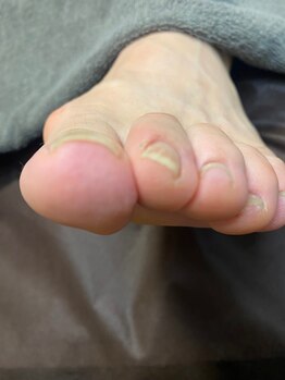 巻き爪矯正after