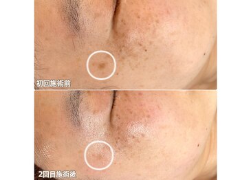 ソイ(Soi)/長年のお悩みも2回でこの結果！