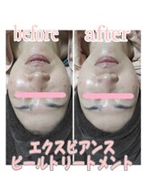 ピュルテ/水光ピールで肌トレーニング！