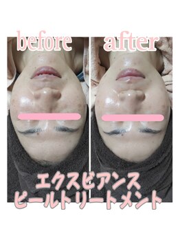 ピュルテ/水光ピールで肌トレーニング!