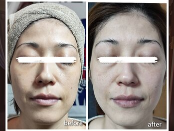 セレナ 川越/フェイシャルエステで変わる!