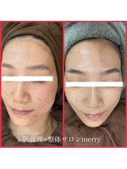 メリー 大和八木店(merry)/一度でもお肌の水分量up!