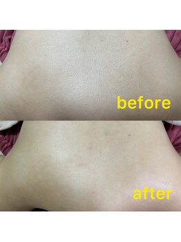 ホヌ(HONU)/お背中シェービング