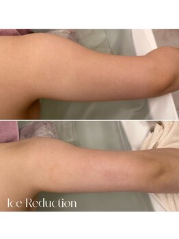 エステティックサロン フェアリー(ESTHETIC SALON FAIRLY)/痩身＊脂肪冷却ビフォーアフター