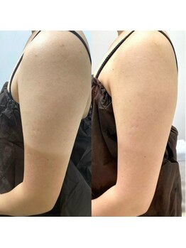 リベル 名古屋(Lebelle:)/ハーブピーリング 名古屋