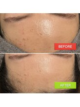 ホイップスパ(WHIP SPA)/毛穴洗浄【1度の効果】