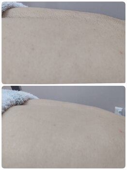 エステシェービングサロン フルール(Fleur)/背中のシェービング