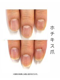 最強ネイルケア