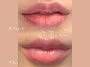 クリアー(CLEAR.)/【Before＆After】ローマピンク