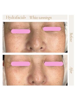 パチュプチ(Patchou petit)/ハイドラフェイシャル×LED