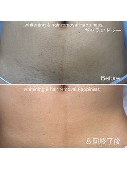 ハピネス 広島並木通り店(Happiness)/へそ下Before→After