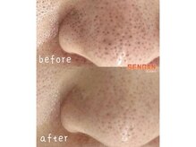 センガン(SENGAN)/気になる黒ずみ毛穴も解消