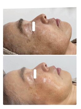 ソフィア わさだ店/セルマン肌質改善10回