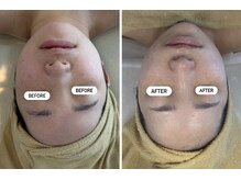 キュアリード(Cure_Lead)/小顔コルギ×プラズマニア