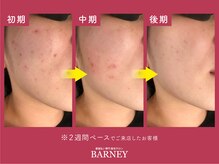 バーニー 梅田店(BARNEY)/顔脱毛の経過【女性】