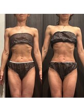 フィエルテ 甲斐敷島(FIERTE)/施術一回 before after