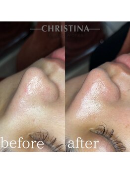 イデアル(Ideal)/【毛穴ケア】ハーブピーリング