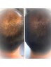 【まるで毛が増えた?!】髪のお悩み、頭皮のお悩みはコレ★