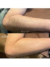 ピーディーエーサロン(PDA salon)/【腕脱毛】