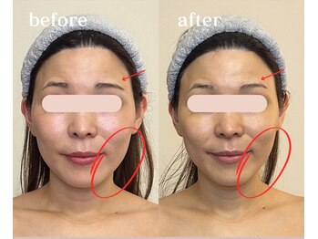 ソルニコン(Solnikon)/若見え小顔術