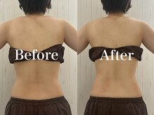 モリタ鍼灸整骨院/【ラジオ波】ボディメイク