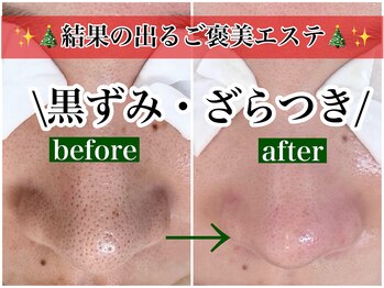 ニュートラル(neutral)/毛穴エクストラクションプロ大分
