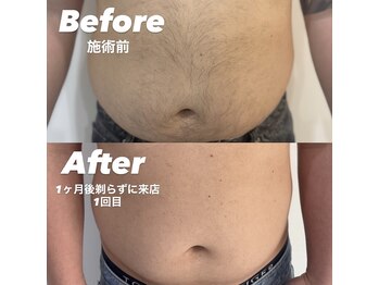 アイリス(IRIS)/【脱毛】お腹 Before After