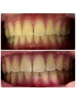 ラブホワイトニング 渋谷店(LOVEホワイトニング)/初回2回照射ホワイトニング