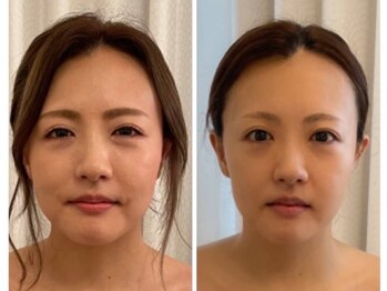 美人バスト 札幌店/小顔コルギ◇症例◇バストアップ