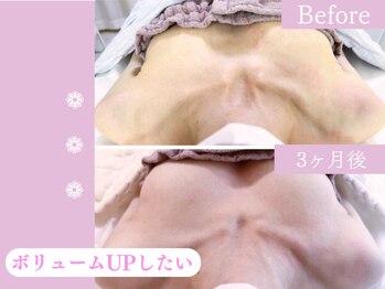 キアナ 横浜店(Kiana)/バストアップBefore After