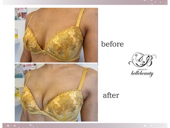 ベルビューティー(belle beauty)/バストアップ◇症例◇
