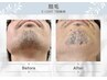 【清潔感UP！】　ひげ脱毛　男性１番人気☆　￥5500