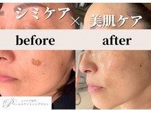 パールホワイトニングサロン 平塚店/シミケアと毛穴ケアが同時に叶う