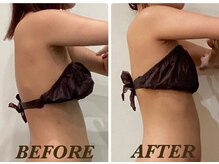 プリマ(Prima)/【2回施術】　BEFORE&AFTER