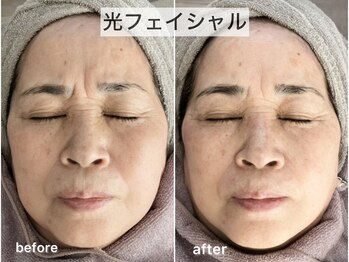 ブルーム(Bloom.)/光フェイシャル