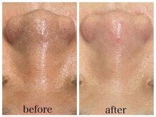 アリエス/ハイドラ×顔脱毛6回の効果